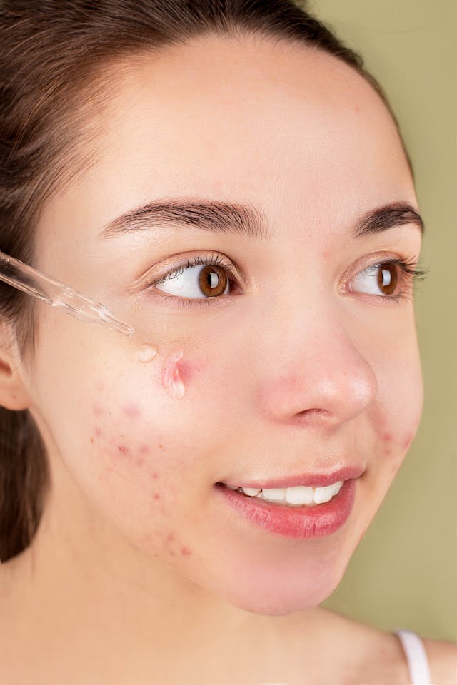 Morpheus8 For Acne Scars
