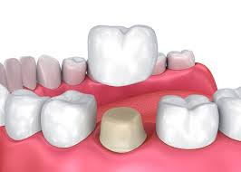 Can Dental Crowns Fall Off